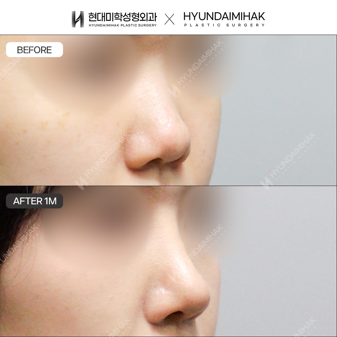 [แก้จมูก] สันจมูก + ปลายจมูก หลังทำ 1 เดือน
