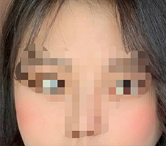 ทำศัลยกรรมแก้โหนกแก้มมาแล้วค่ะ~ ขอบคุณที่ทำให้อย่างสวย^^
