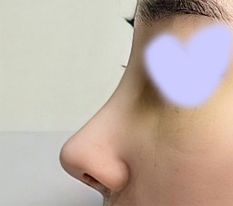 ผ่านมา 2 สัปดาห์แล้วหลังผ่าตัดแก้ไขจมูก~~!