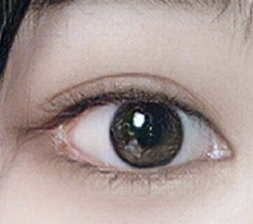 ผ่าตัดเปิดหัวตา-หางตา 2 เดือนแล้ว ดูดีนะ??
