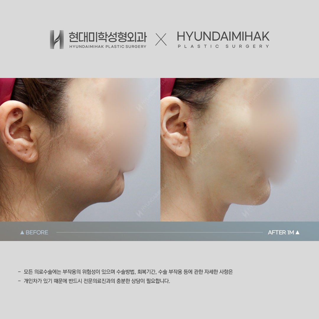 [ศัลยกรรมหน้าเด็ก] ร้อยไหม ครบ 1 เดือน