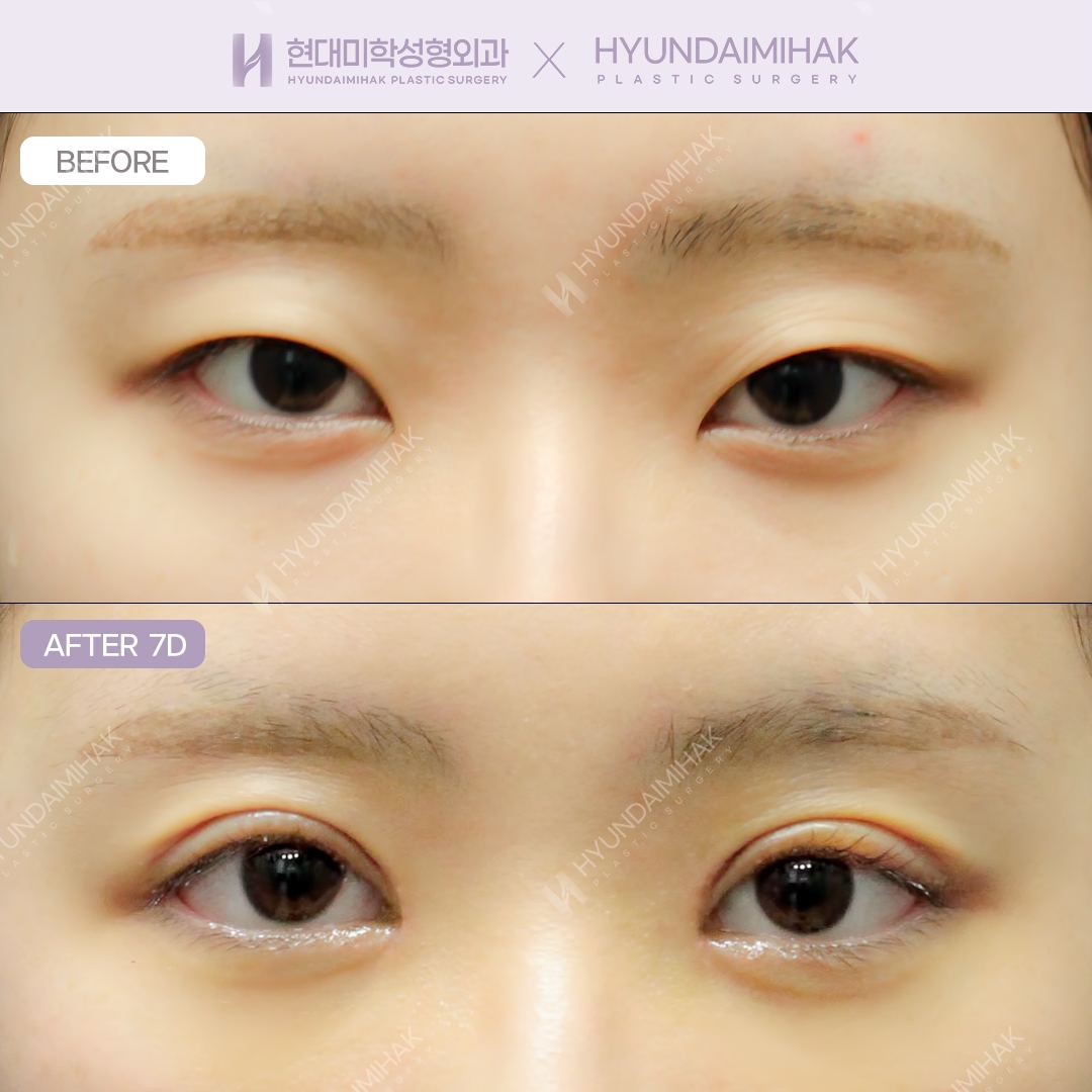 กรีดตาสองชั้น + เปิดหางตาแบบดูอัล