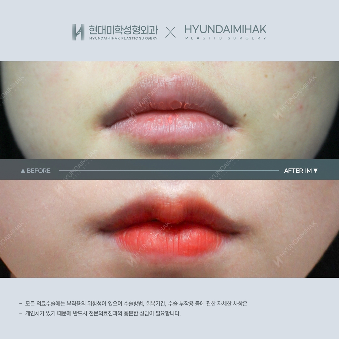 [ศัลยกรรมริมฝีปาก] ศัลยกรรมริมฝีปากคิวปิด ครบ 1 เดือน