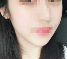 รีวิวลดปลายคาง!!~