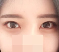 ทั้งหมดเพราะ Dual Epicanthoplasty