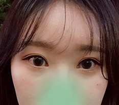 เปลี่ยนภาพลักษณ์สำเร็จด้วยแก้กล้ามเนื้อตาและเปิดตา :)