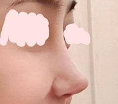 ความเปลี่ยนแปลงหลังแก้จมูก