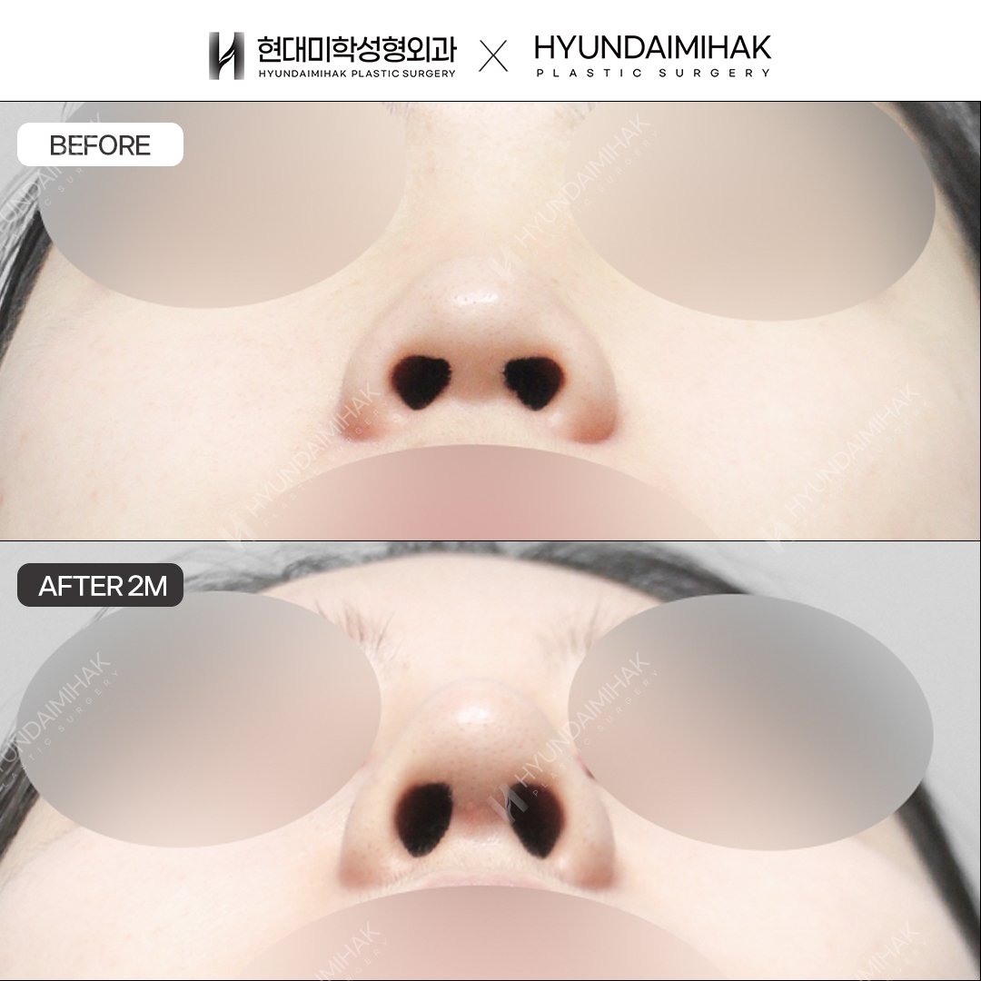 [เสริมจมูกโด่งสำหรับจมูกเตี้ย] สันจมูก + ปลายจมูก ครบ 2 เดือน