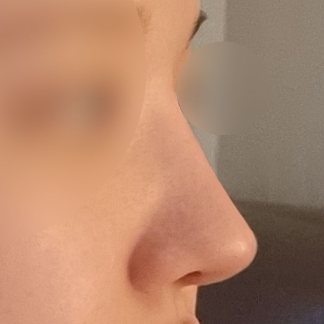 รีวิวทำจมูก แก้จมูกไม่สวยที่อยู่กับฉันมา 25 ปี