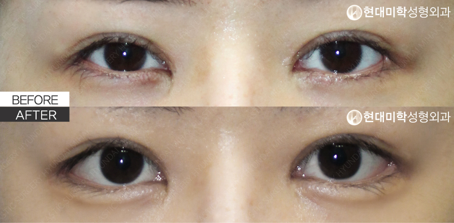 ทำถุงใต้ตาแบบไม่กรีด + เปิดหางตาแบบ Dual (ผ่าตัดแก้)