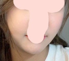 รีวิวจริงหลังผ่าตัดโหนกแก้มครบ 2 เดือน~