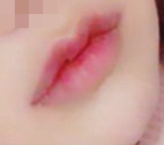 I highly recommend Hyundai Thailand mouth-corner + Cupid lip surgery