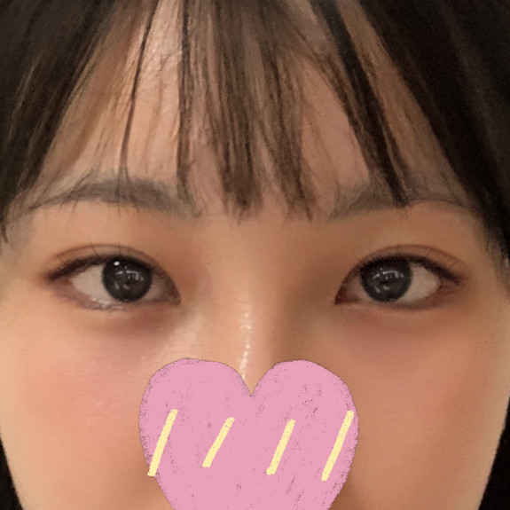 รีวิวเปิดหางตาและแก้ตาสองชั้นสำหรับตาเล็กแคบค่ะ