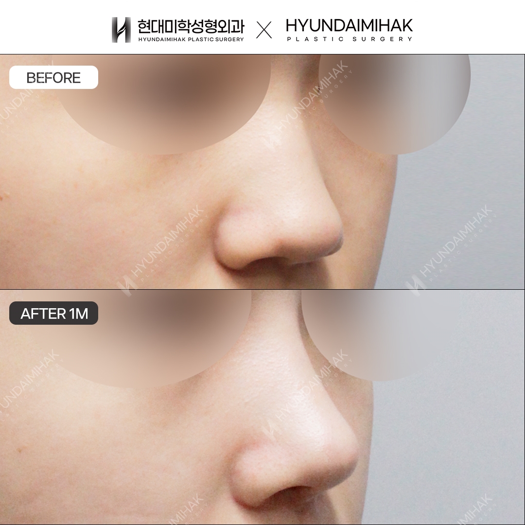 [ศัลยกรรมจมูกเตี้ย] สันจมูก + ปลายจมูก ครบ 1 เดือน