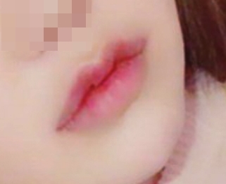 ผ่าตัดริมฝีปากแปลกดีมาก~~