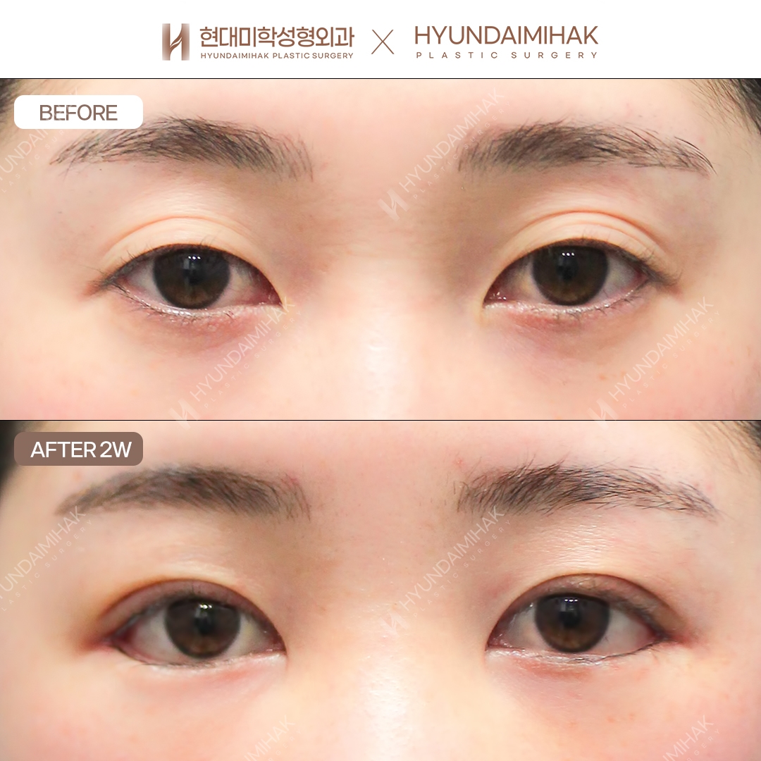 [แก้ตาสองข้างไม่เท่ากัน] กรีดตาสองชั้น + ปรับกล้ามเนื้อตา + เปิดหางตาแบบดูอัล