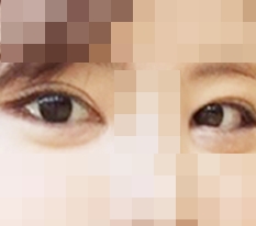 ทำแก้ตากับเปิดตาแบบเต็มมาแล้ว!!