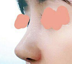 มาเขียนรีวิวแก้จมูกค่ะ haha