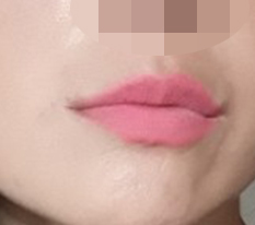ศัลยกรรมปากเป็นยังไงบ้างคะ? ดูสำเร็จใช่ไหม??