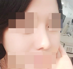 ผ่าตัดจมูกดีที่สุด พอใจมากๆ ♥!!