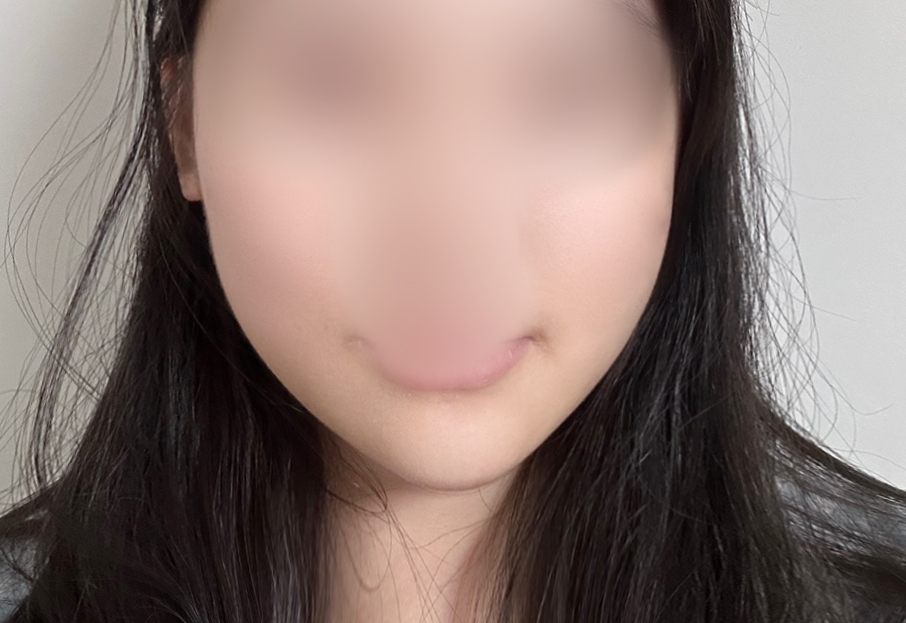 แก้ความไม่เท่ากันของใบหน้าด้วยร้อยไหม