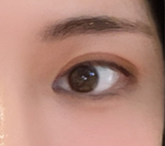 ผ่าตัดออกมาดีมากค่ะ