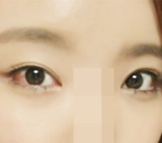 ฉันทำ Perfect Big Eye + Dual Canthoplasty แล้ว