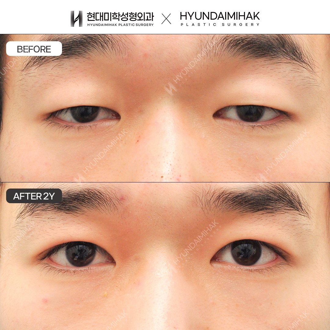 [ศัลยกรรมตาผู้ชาย] แก้กล้ามเนื้อตาแบบไม่กรีด