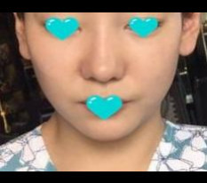 ดีใจที่จมูกสวยขึ้นค่ะ!