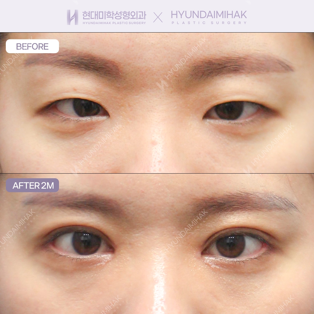 กรีดทำตาสองชั้น + เปิดหางตาแบบคู่ + เปิดหัวตา