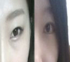 เปิดหางตาแบบดูอัลกับเย็บจุดทำตาสองชั้น! เปลี่ยนเป็นตาสวยแล้ว~^0^