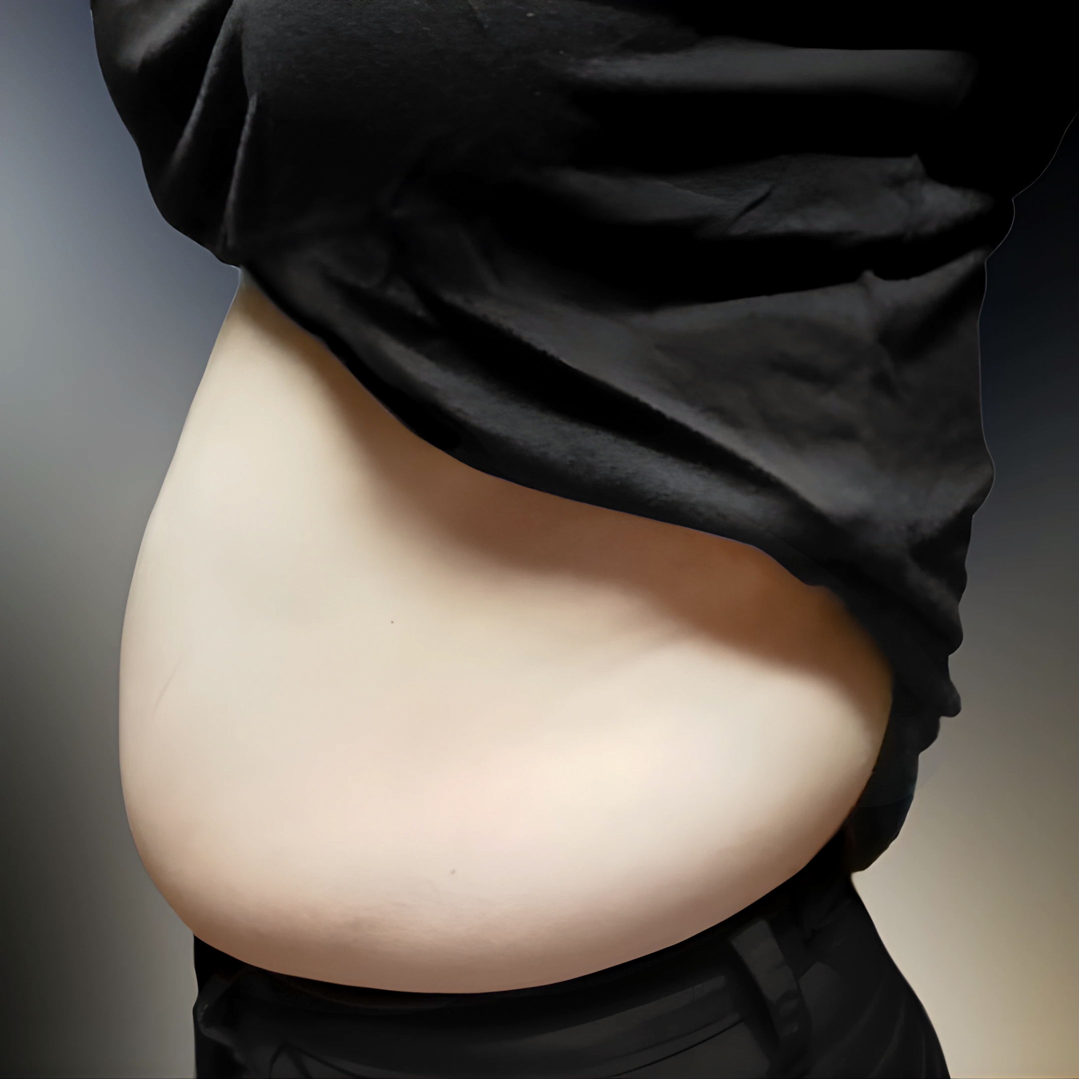 ไปตัดไขมันหน้าท้องมาแล้ว #lovehandles #เอวข้าง #เอวหลัง #หน้าท้อง