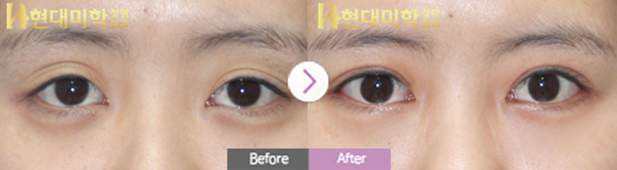 แก้ไขตาสองชั้นแบบกรีด, แก้ไขกล้ามเนื้อตา, เปิดหางตา, เปิดใต้ตา, ศัลยกรรมเปลือกตาบน