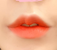 My impression and vibe changed thanks to mouth-corner surgery!
