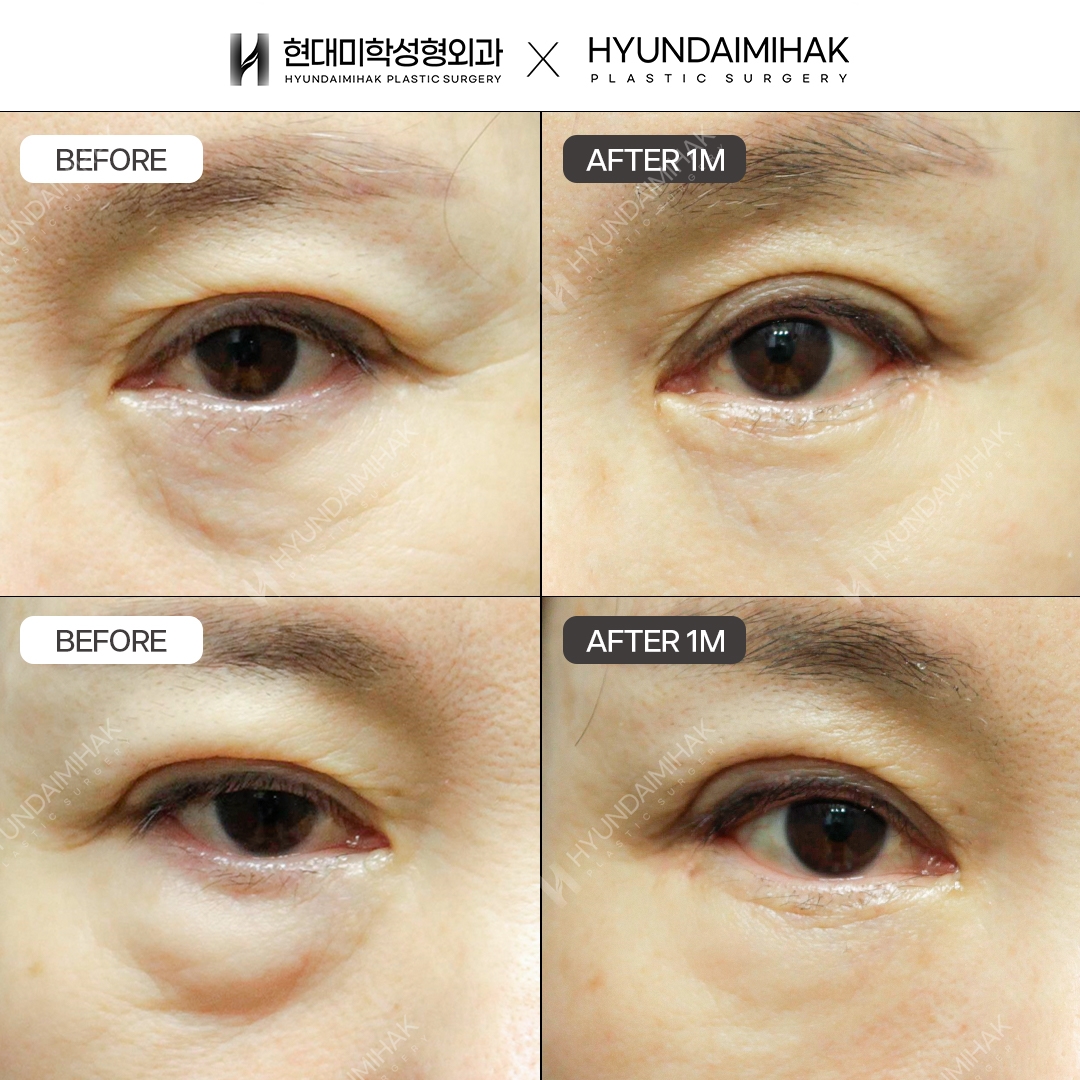 [ศัลยกรรมตาวัยกลางคน] หนังตาบน + หนังตาล่าง + จัดเรียงไขมันใต้ตา