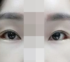ผ่าตัดหัวตาและหางตา ♥~