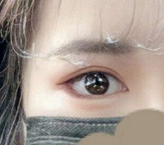 แก้ตาแล้วออกมาดีไหม??