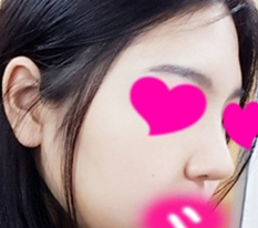 จากจมูกเหมือนฟักทองเป็นจมูกเหมือนแตงกวา lol
