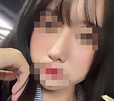 แก้ปัญหาจมูกต่ำ