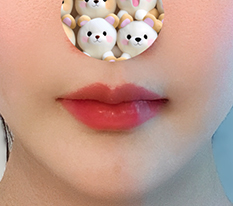 ผ่าตัดเส้นคิวปิดโดยไม่มีแผลเป็น