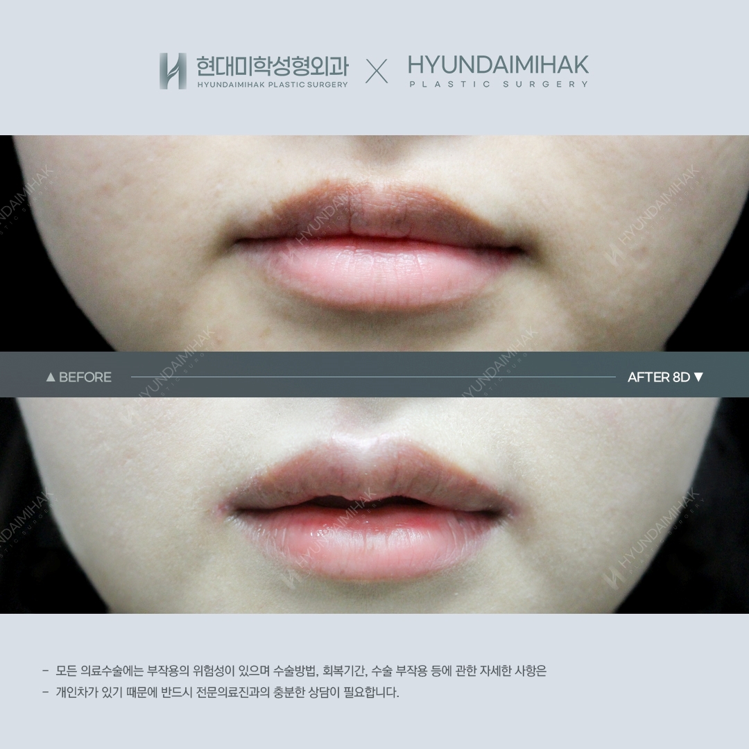 [ศัลยกรรมริมฝีปาก] ศัลยกรรมริมฝีปากคิวปิด ครบ 1 เดือน