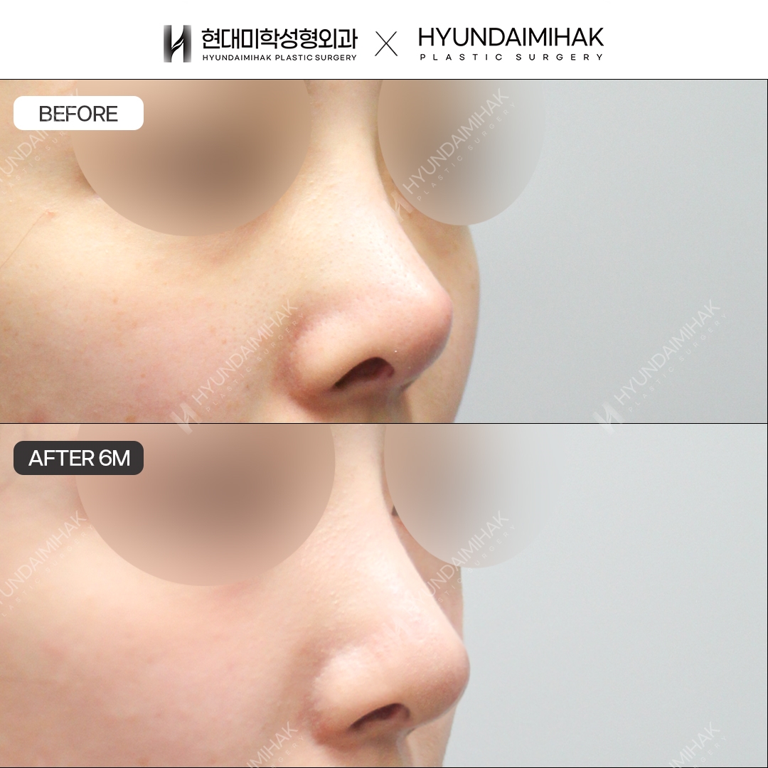 [แก้จมูกซ้ำ] สันจมูก + ปลายจมูก ครบ 6 เดือน