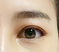 ผ่านไปหนึ่งอาทิตย์แล้วหลังผ่าตัดแก้ไขตาสองชั้น^^