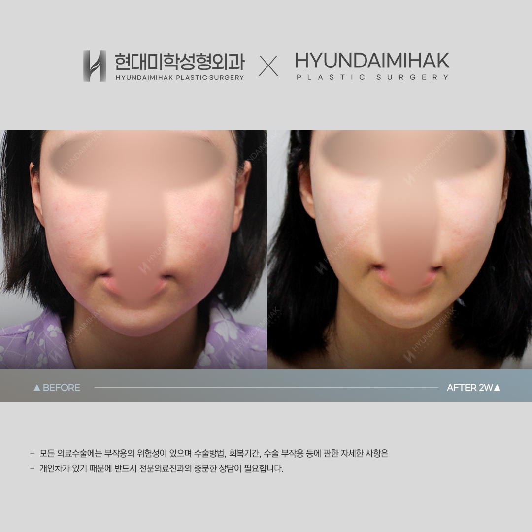 [ศัลยกรรมหน้าเด็ก] ร้อยไหม 2 สัปดาห์