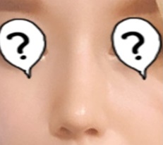 My unattractive nose changed my whole image after rhinoplasty at Hyundai Thailand!