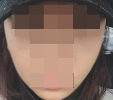พอลดโหนกแก้มแล้วภาพลักษณ์เปลี่ยนไปคนละแบบเลยค่ะ♥