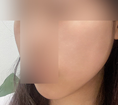 ในที่สุดก็รีวิวฉีดปรับรูปหน้า!