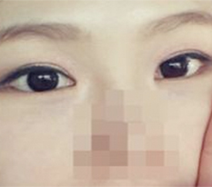 รีวิวผ่าตัดตา พอใจมากค่ะ^.^/