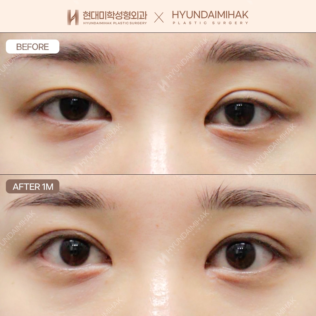 [ศัลยกรรมตาแก้ไข] กรีดตาสองชั้น + แก้กล้ามเนื้อตา