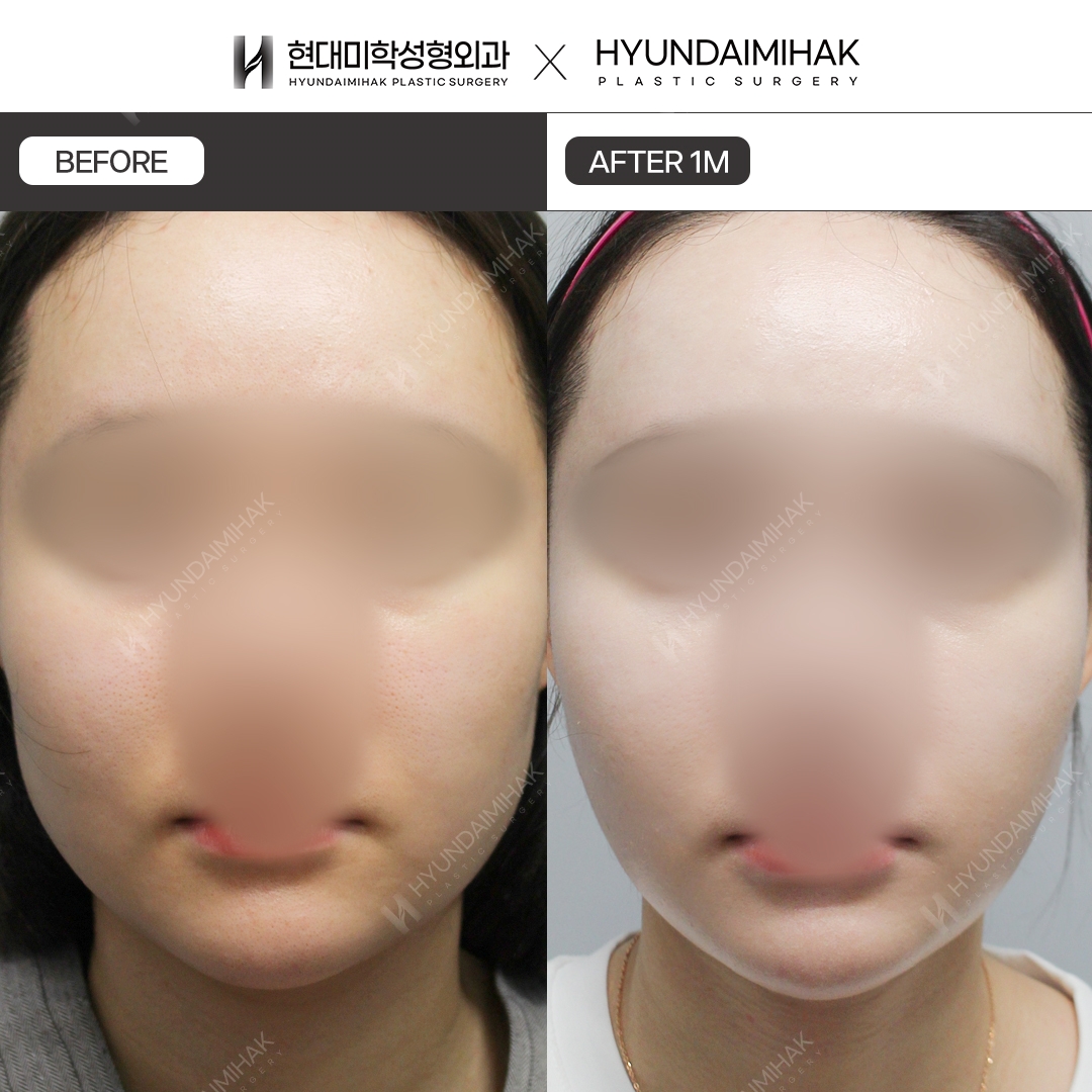 [ยกกระชับ] ร้อยไหมเหนียงใต้คาง หลังทำ 1 เดือน